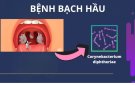 Bài tuyên truyền: PHÒNG CHỐNG BỆNH BẠCH HẦU