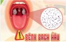 BÀI TUYÊN TRUYỀN PHÒNG CHỐNG BỆNH BẠCH HẦU